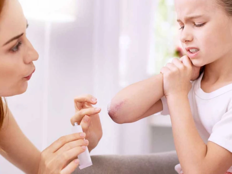 Pilih Plester Sesuai Jenis Luka, Bisa Cegah Risiko Infeksi